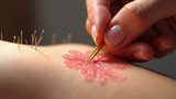 Acupuncture needle insertion techniques affect connective tissue