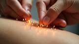 Acupuncture stimulates the body's healing processes with fine needles