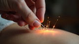 Acupuncture requires a high level of skill