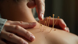 Acupuncture techniques are shaped by local health philosophies