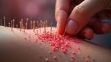 Acupuncture can cause bacterial infections